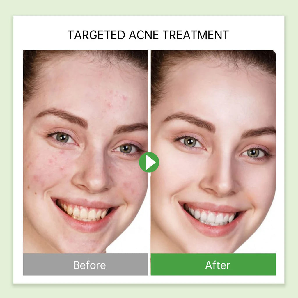 Jelly Prim Tea Tree Acne Treatment Serum