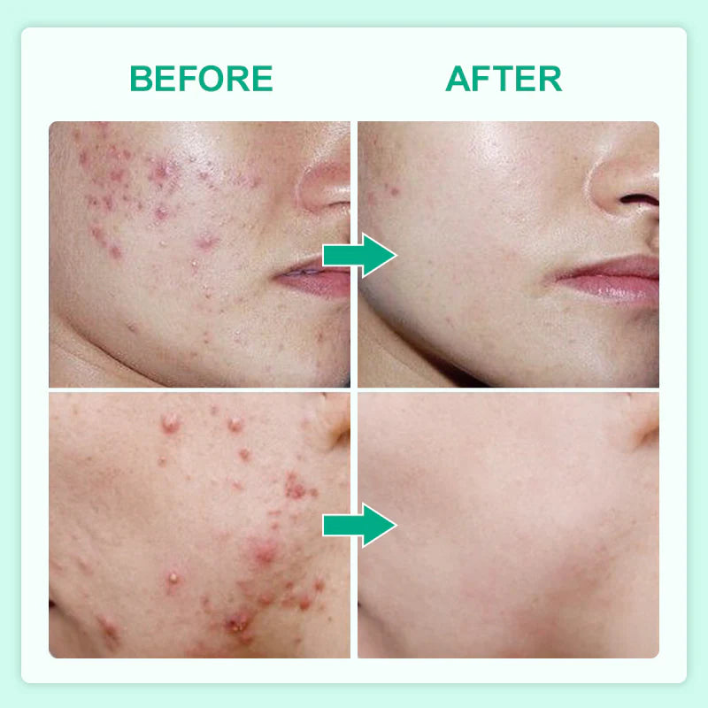 Double Effect Acne Removing Serum