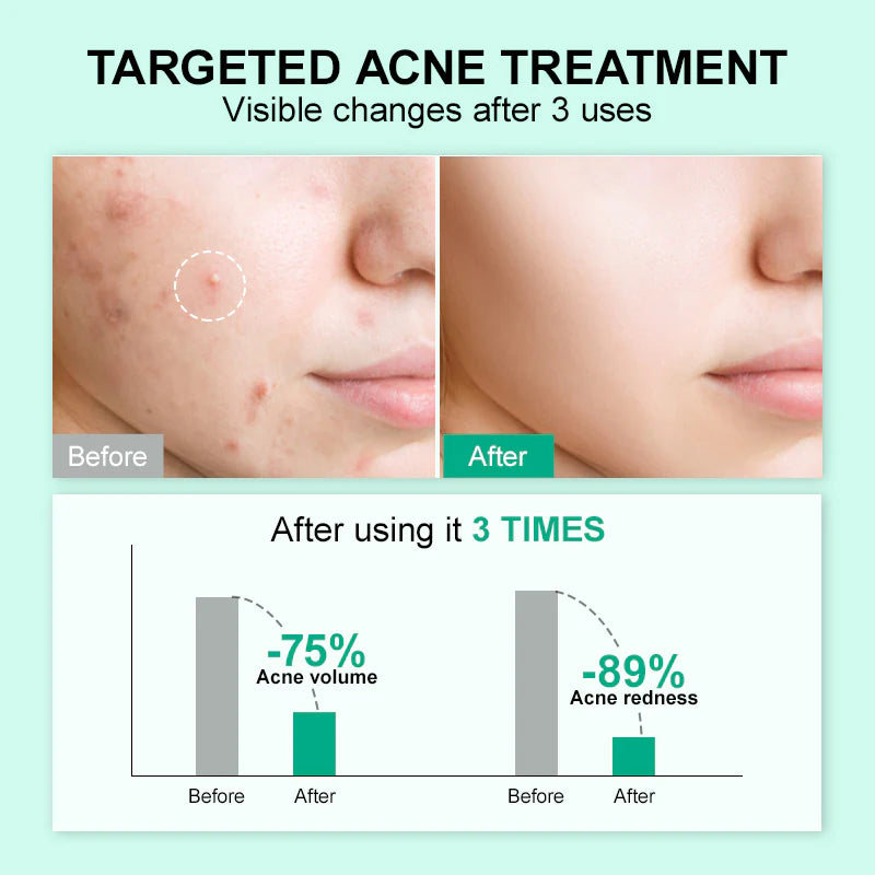 Double Effect Acne Removing Serum